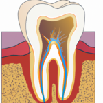 איך נוצרים חורים בשיניים ועששת ואיך להימנע מהם