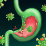 וירוס קיבה / בטן: התסמינים, הגורמים ודרכי טיפול